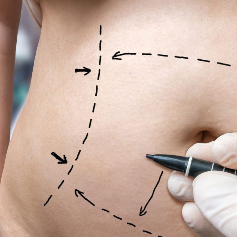 Cobertura de cirurgia plástica reparadora a pacientes de bariátrica